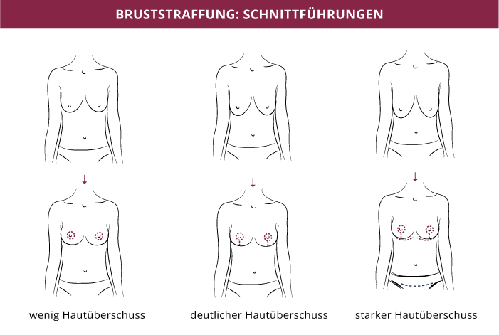 Bruststraffung In Stuttgart Klinik Auf Der Karlshohe