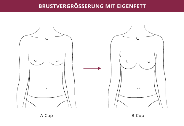 Brustvergrößerung mit Eigenfett, Klinik auf der Karlshöhe, Dr. Fitz.